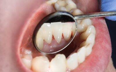 Wieso ist eine professionelle Zahnreinigung gerade während der COVID-19-Pandemie sinnvoll?